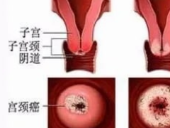 我被告知我怀孕了。然后我发现这...很可能是癌症？