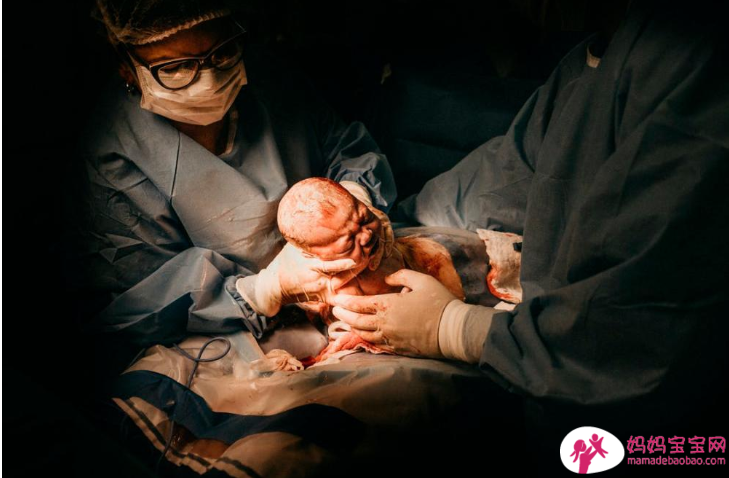 剖腹产变得普遍