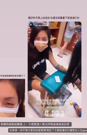 梁云菲经痛吃止痛药药物过敏　半夜急诊「肿到一只眼快睁不开」