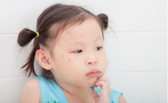 别误认成毛囊炎！孩子皮肤出现珍珠串小疹是（传染性软疣病毒）