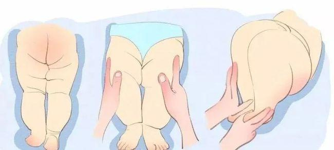 宝宝腿纹不对称 可以这样做