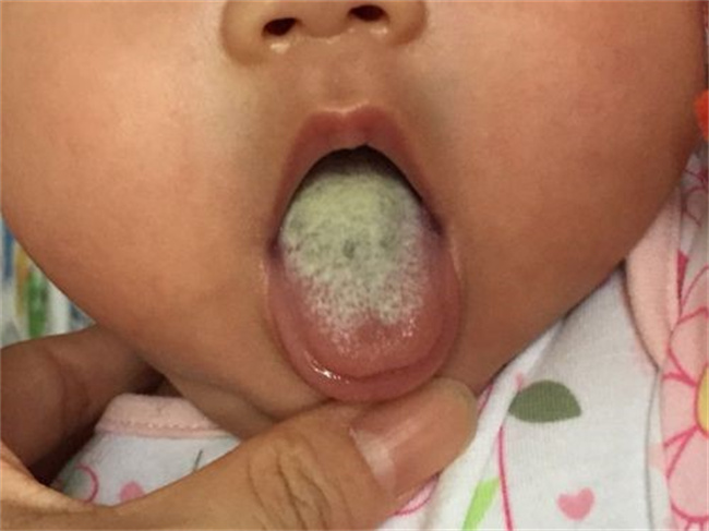 孩子舌苔厚是怎么回事 应该怎么办