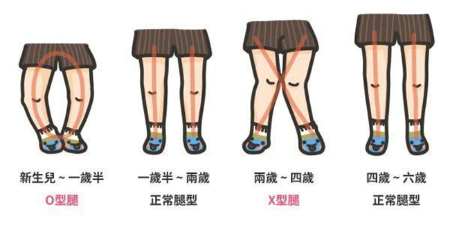 宝宝过早学会走路会导致腿部变形吗（会）