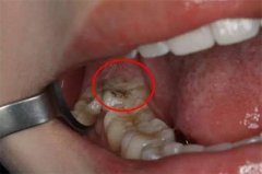 孩子新牙长出来了智齿还没掉 应该怎么处理（到口腔科拔掉）