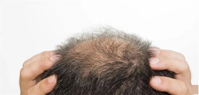 孩子的头发又黄又少 是缺乏哪些营养（维生素）