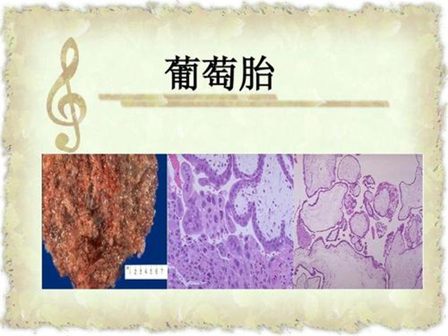 葡萄胎是如何形成的（年龄，身体，营养等）