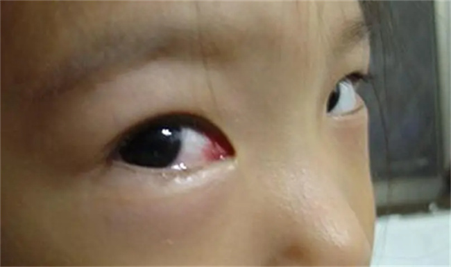 宝宝过敏性结膜炎是什么原因导致的（过敏体质）