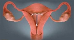 取环以后没有避孕 一直不怀孕是什么原因（子宫内膜受损）