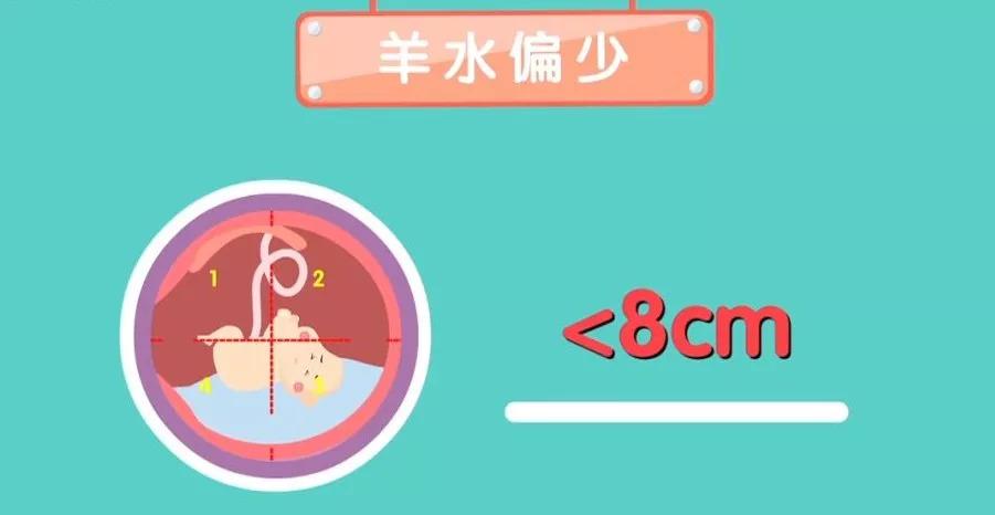 孕妇羊水过少有什么危害（胎儿畸形，孕妇腹痛）