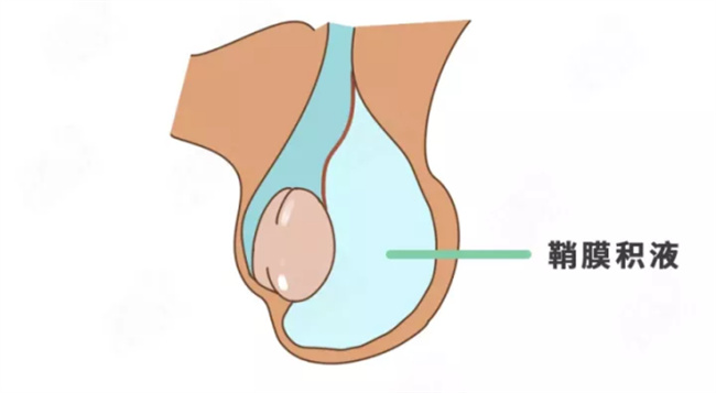 导致小儿阴囊积水的主要原因，病发治疗方法（原因较多，及时就医）