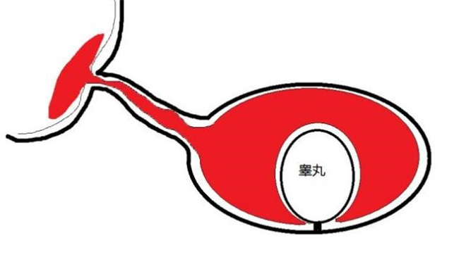 导致小儿阴囊积水的主要原因，病发治疗方法（原因较多，及时就医）