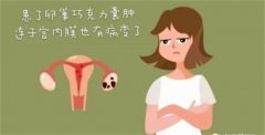 巧克力囊肿有哪些症状