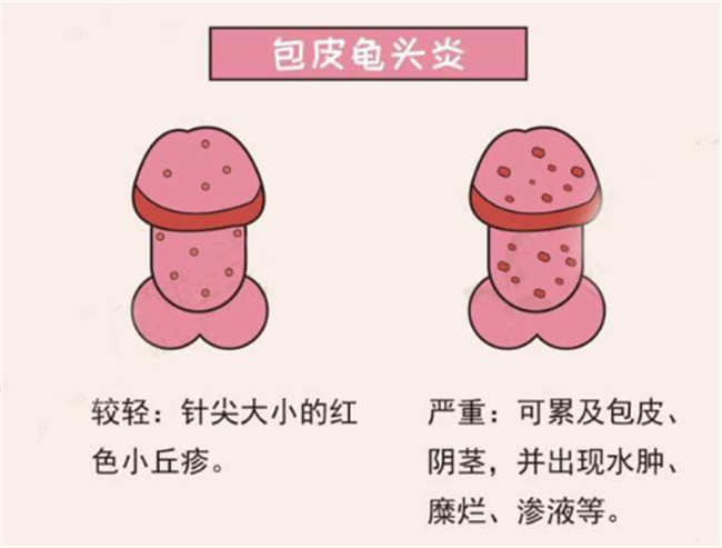 龟头炎应该怎样治疗