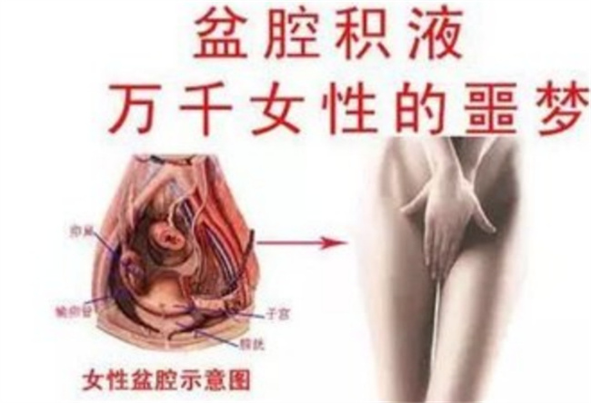 女性盆腔积液有哪些症状