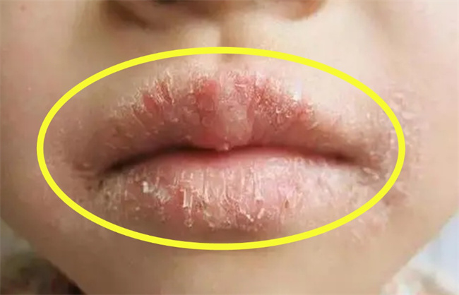 宝宝嘴唇干应该怎样护理