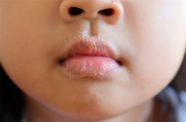 宝宝嘴唇干应该怎样护理