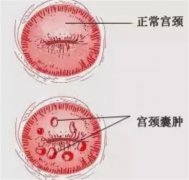 宫颈囊肿发病的原因有哪些