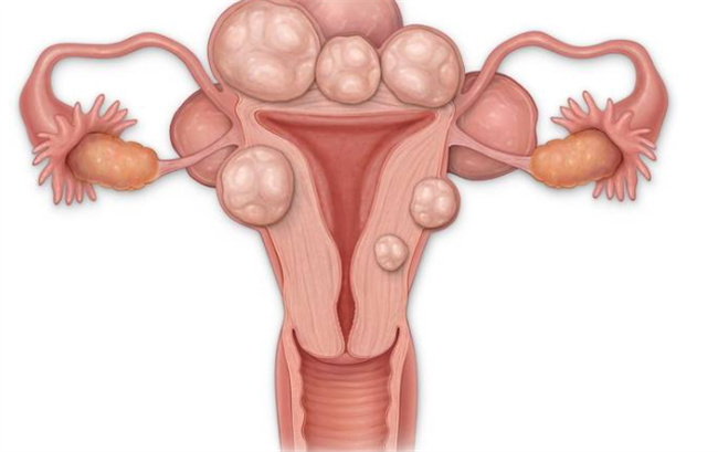 宫颈囊肿发病的原因有哪些