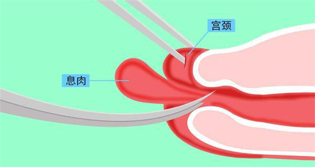 宫颈息肉术后的注意事项