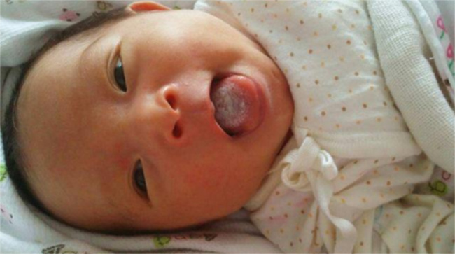 婴儿舌苔厚白应该怎么处理