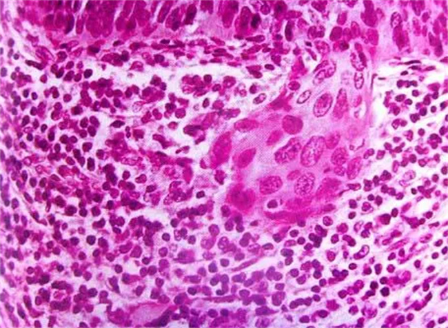 宫颈原位癌可以治好吗