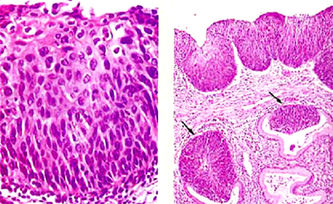 宫颈原位癌可以治好吗