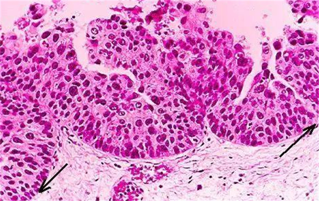 宫颈原位癌早期有哪些症状
