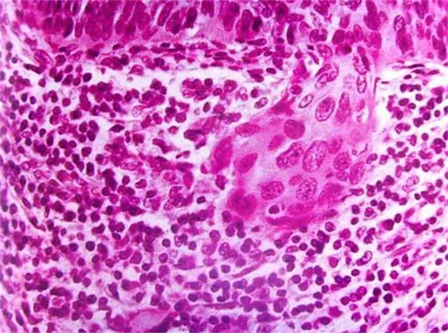 宫颈原位癌早期有哪些症状