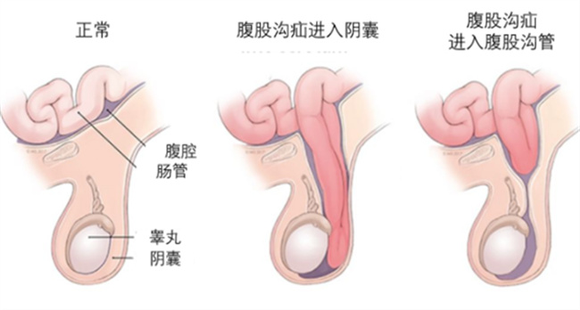 哪些原因会引起腹股沟疝气