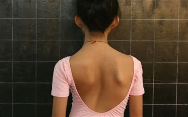 如何治疗脊柱侧弯