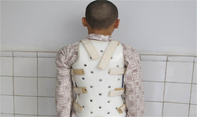 如何治疗脊柱侧弯