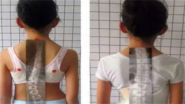 如何治疗脊柱侧弯