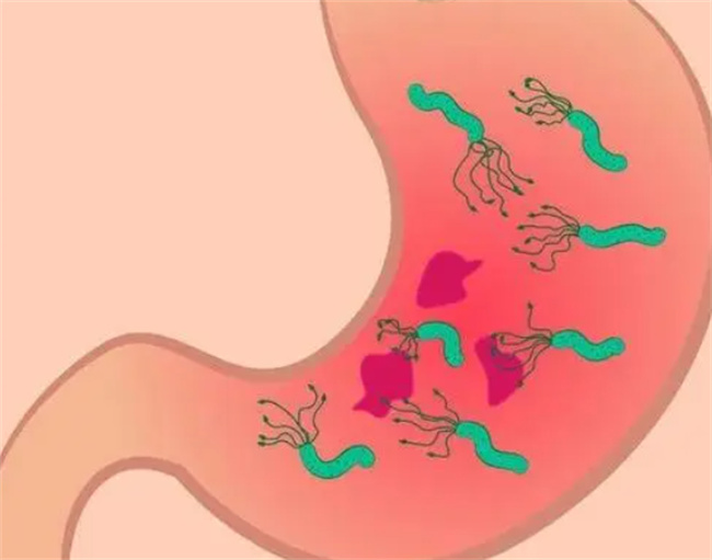 幽门螺旋杆菌患者的护理