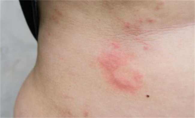 人工性荨麻疹有哪些注意事项