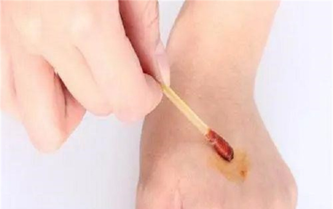 处理伤口正确的方法