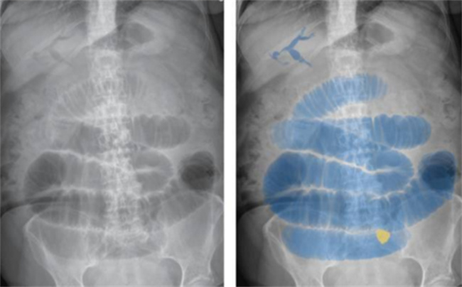 发现幼儿生理性肠扩张后怎么有效治疗