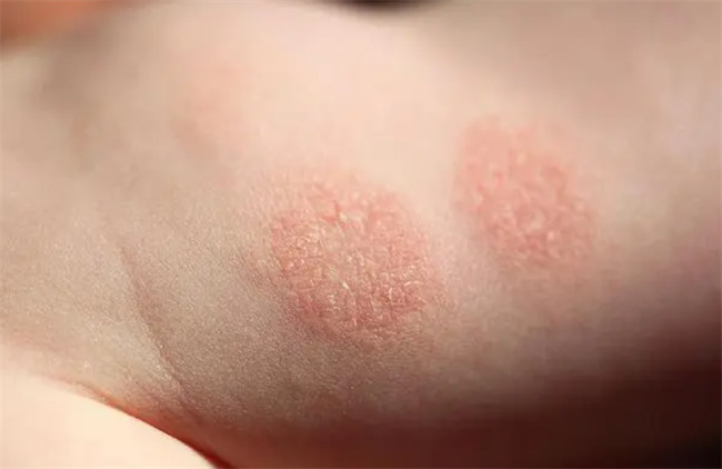 儿童特应性皮炎是什么原因引起？怎么有效治疗？