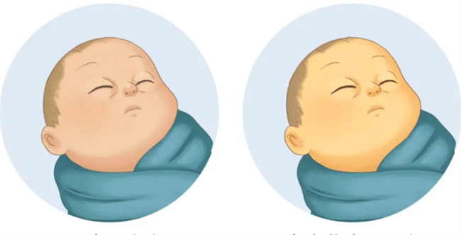 新生儿黄疸的原因是什么