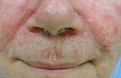 脂溢性皮炎的症状及表现详解，了解头皮和身体不同部位的临床表现