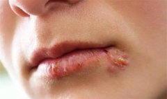 深度了解单纯疱疹病毒：传染性皮肤病的历史与特征