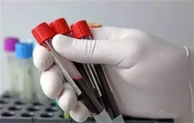 梅毒甲苯胺红不加热血清试验1:4：探究与治疗方法解析