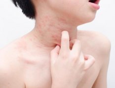 湿疹性皮炎的治疗与关注：专业观点解析