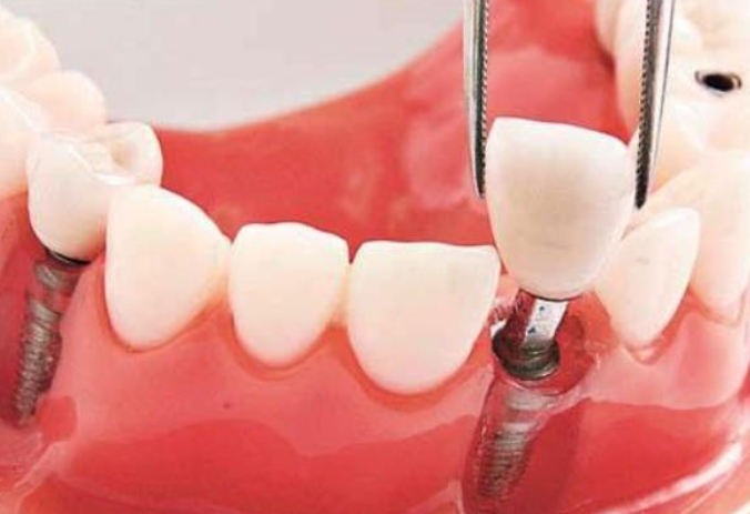 拔牙后的完美恢复：假牙镶接的最佳时机