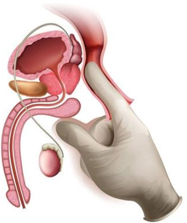 解析前列腺炎症：综合治疗之道