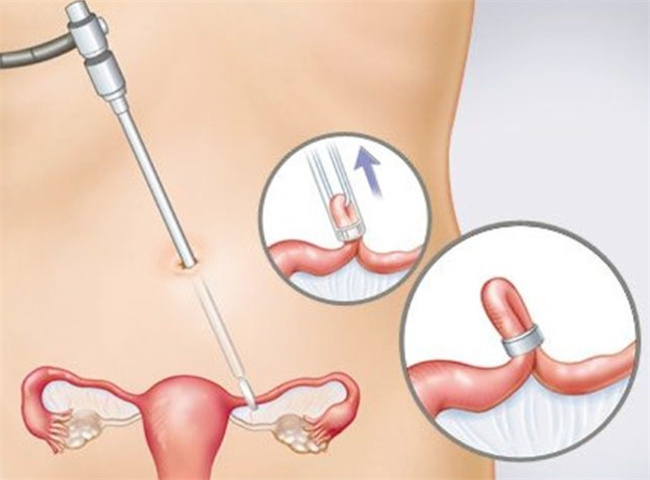 女性结扎手术后的恢复与注意事项