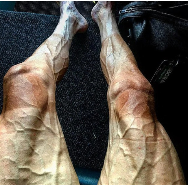 告别脚气的小窍门：如何治疗和预防严重脚气