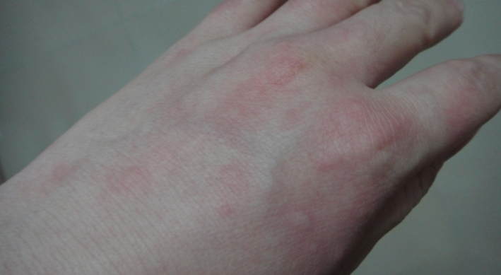 皮疹的治疗策略与注意事项