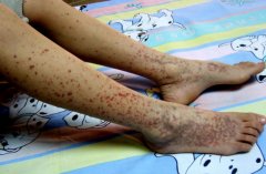 过敏性紫癜：不传染的疾病，但需要警惕