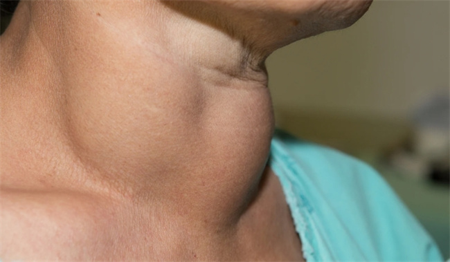 探讨甲状腺肿大的成因