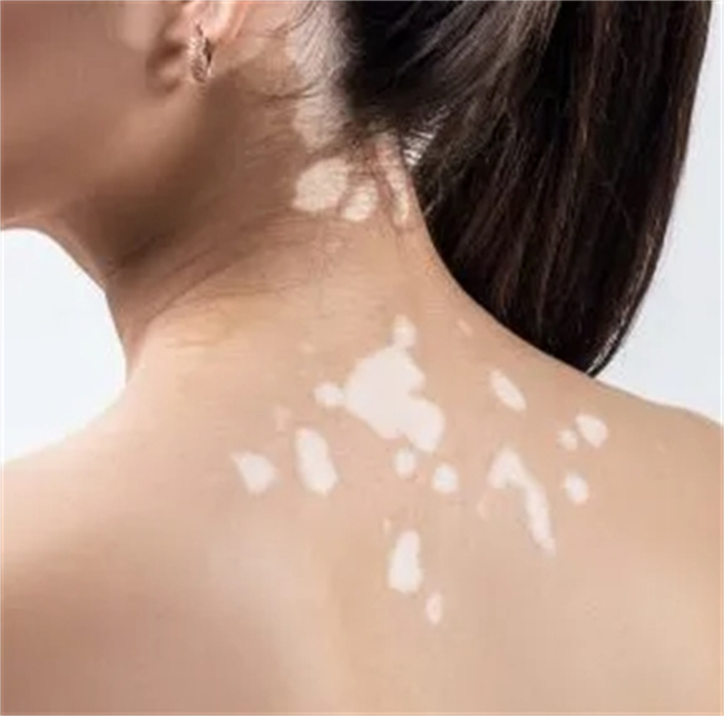 白癜风初期症状揭秘：从白斑到色素变化